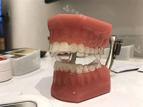 隐形牙齿矫正牙套模型