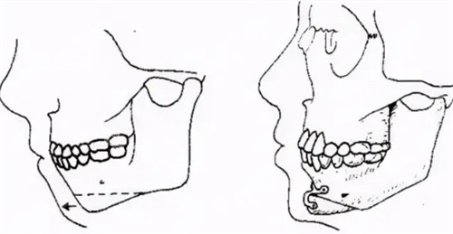 颏成形术手术过程