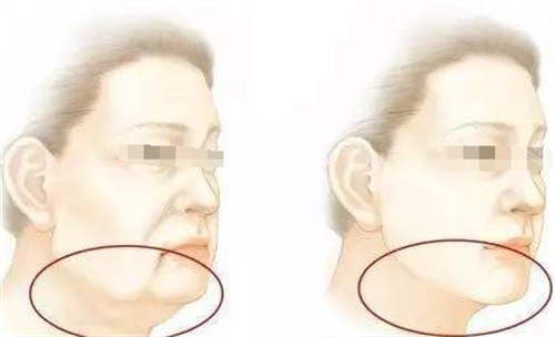 微拉美面部提升动画前后对比图 微拉美面部提升动画前后对比图