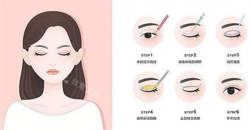 全切雙眼皮過(guò)程卡通圖 全切雙眼皮過(guò)程卡通圖