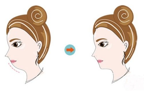 正颌前后示意图 正颌前后示意图