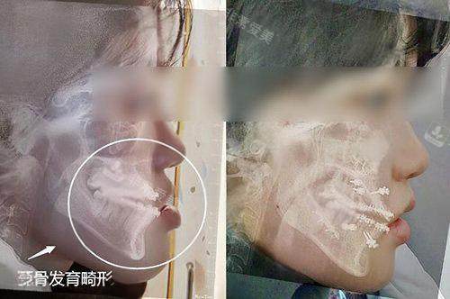 地包天正颌手术前后对比 地包天正颌手术前后对比