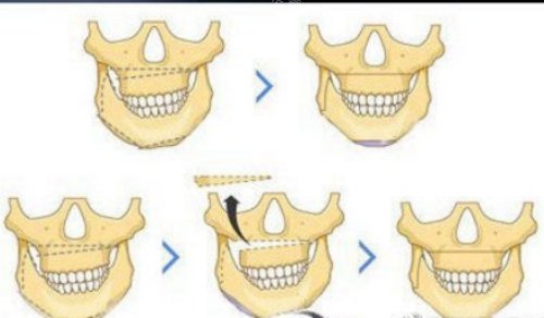 正颌流程示意图 正颌流程示意图
