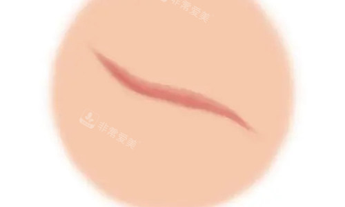 疤痕增生的不同动画展示图 疤痕增生的不同动画展示图