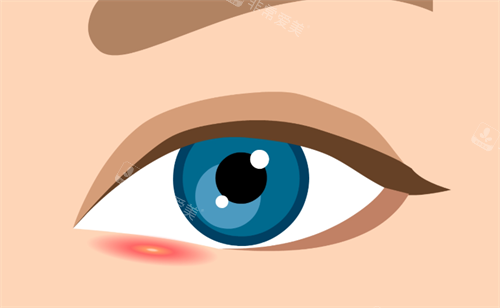 双眼皮疤痕 双眼皮疤痕