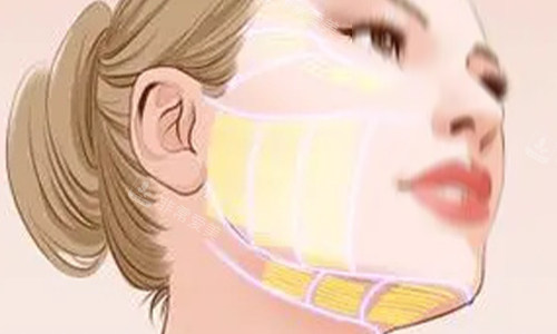 拉皮手术范围示意图 拉皮手术范围示意图