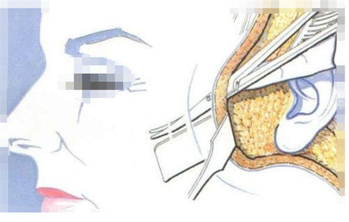 拉皮手术手术剖面图 拉皮手术手术剖面图