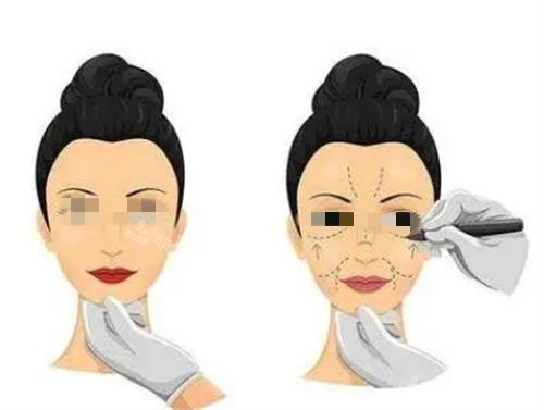 拉皮手术术前画线图 拉皮手术术前画线图