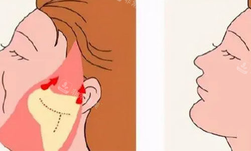 拉皮手术的术后对比图 拉皮手术的术后对比图