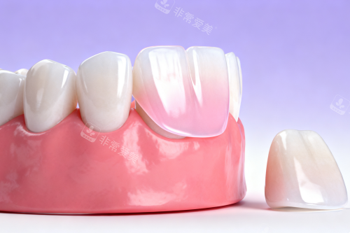 牙贴面卡通展示图