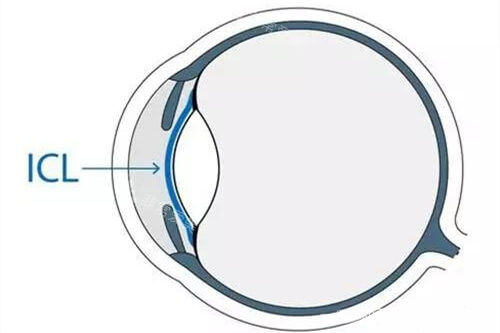 ICL晶体植入近视眼手术眼球位置示意图