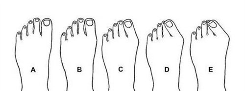拇外翻程度 拇外翻程度