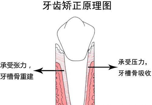 牙齿矫正正畸原理
