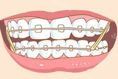 牙齿矫正卡通图片展示