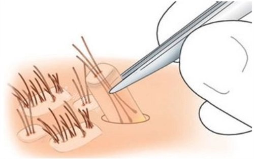 提取毛囊示意图 提取毛囊示意图
