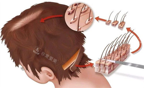 毛囊移植部位演示图 毛囊移植部位演示图