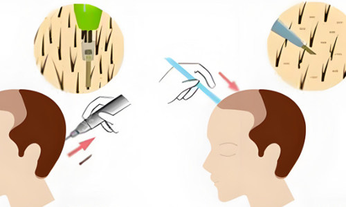 后枕部位取毛囊植发展示 后枕部位取毛囊植发展示