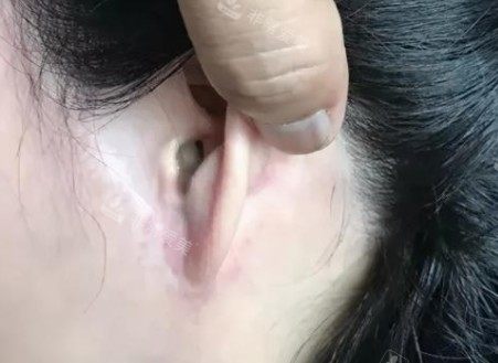 拉皮手术疤痕图