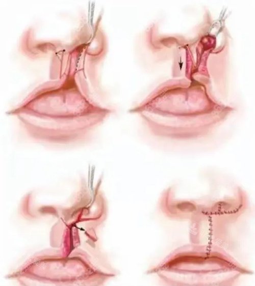 唇裂修复手术卡通图