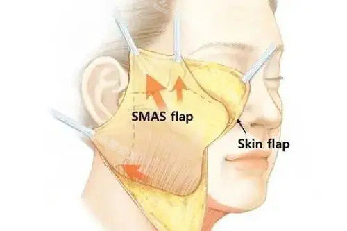 面部拉皮卡通示意图 面部拉皮卡通示意图