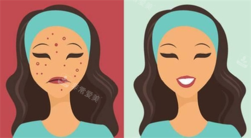 祛痘前后对比图 祛痘前后对比图
