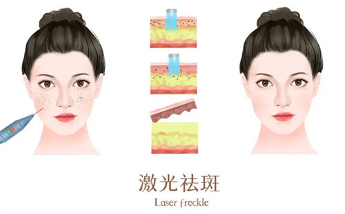 激光祛斑前后 激光祛斑前后