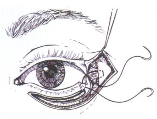 外眼角缝合动画示意图.jpg