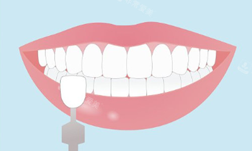 牙齿贴面示意图