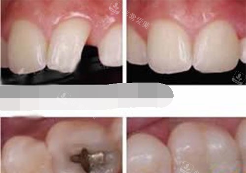 补牙过程