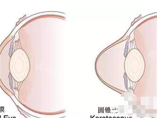 眼角膜前后对比动画展示