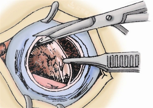 眼角膜割除动画展示