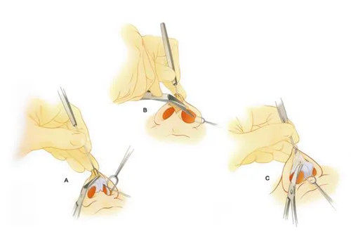 隆鼻整形切口示意图 隆鼻整形切口示意图