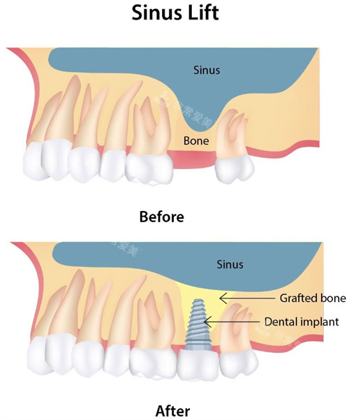 上颌窦提升前后对比 上颌窦提升前后对比