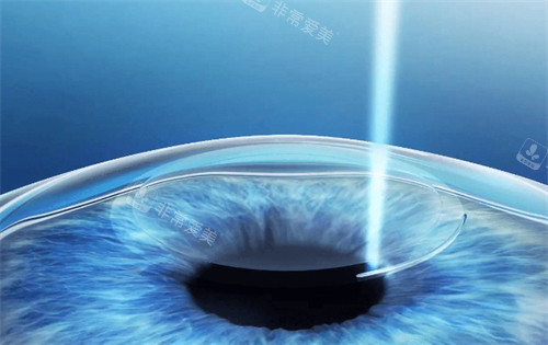 绿飞秒手术过程图解