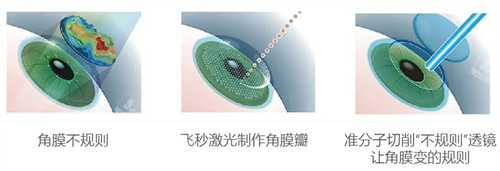 个性化微飞秒手术与传统近视手术的区别图解