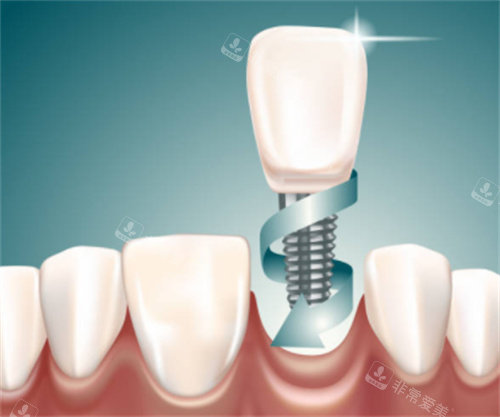 种植牙在口腔图
