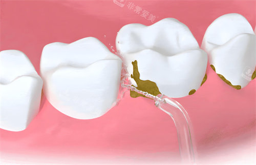 洗牙过程卡通图