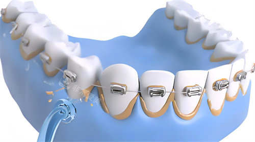 洗牙过程动画展示图片