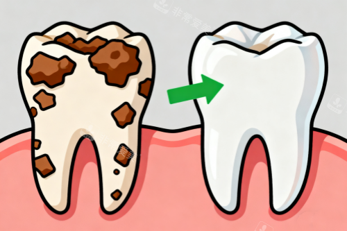 洗牙前后对比图