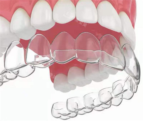 隐形矫正牙齿示意图