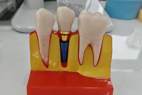 种植牙模型实拍