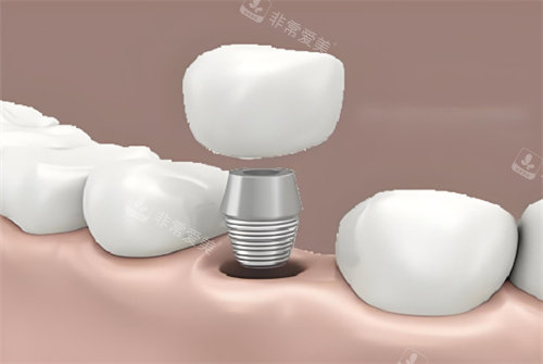 种植牙图片展示图片