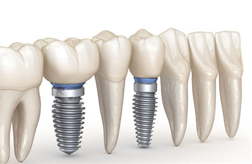 种植牙动画图片展示