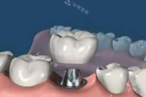 单颗种植牙卡通图片展示