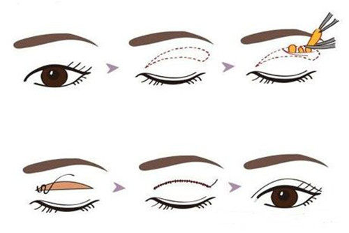 切开法眼部整形示意图 切开法眼部整形示意图