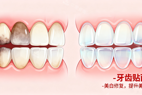 牙齿贴面前后对比图展示