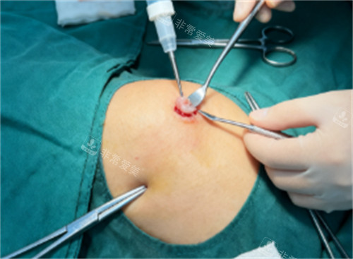 奥美定取出过程