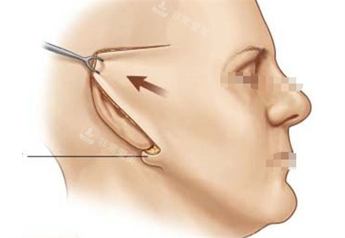 拉皮手术切口展示 拉皮手术切口展示
