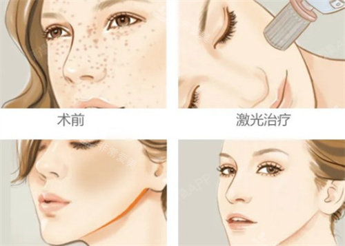激光祛斑术前术后对比 激光祛斑术前术后对比