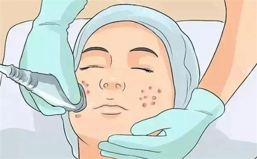祛痘治疗 祛痘治疗